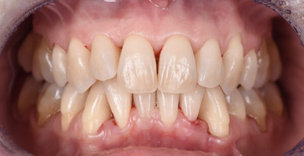 Traitement parodontal - Easy Good Smile