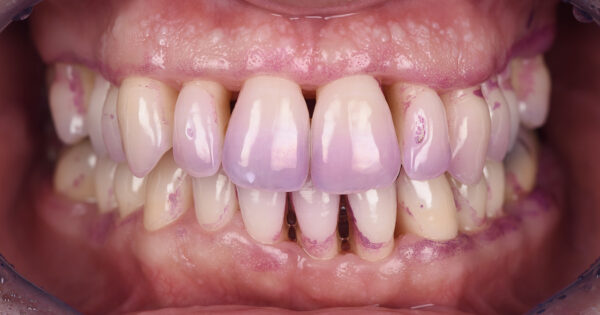 Traitement parodontal - Easy Good Smile