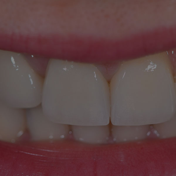 Formation facettes dentaires EGS - Cas clinique